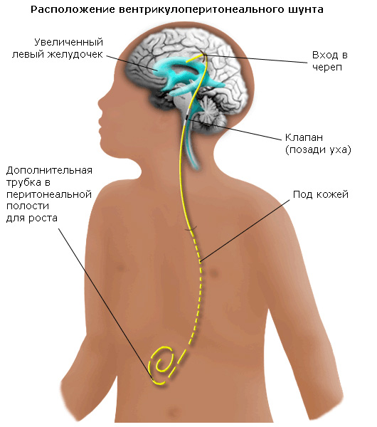 Форма головы при гидроцефальном синдроме фото thumbnail