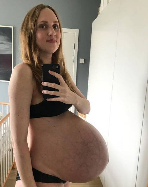 Беременность тройней 35 недель