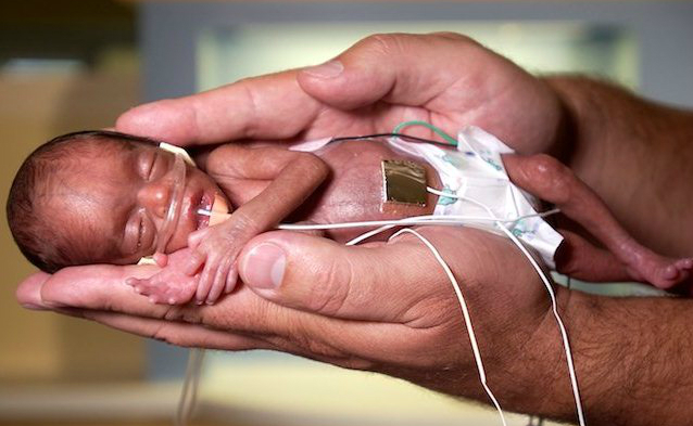 Недоношенный новорожденный ребенок. 24 недели беременности