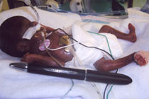 Врачи спасли новорожденную девочку весом 284 грамма